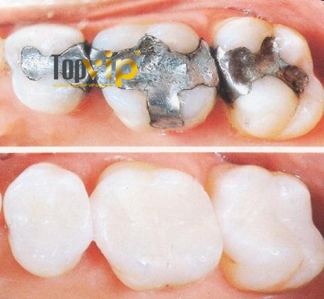 Kết quả hàn trám răng tại Nha khoa Lạc Việt