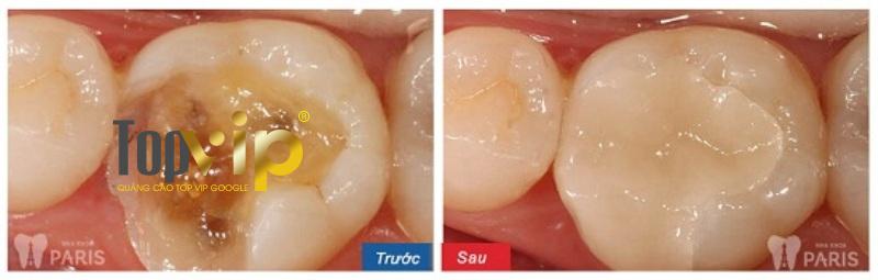 Kết quả trám răng của khách hàng tại Nha khoa Paris