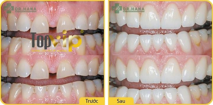 Kết quả sau hàn trám tại Viện thẩm mỹ quốc tế Dr. Hana